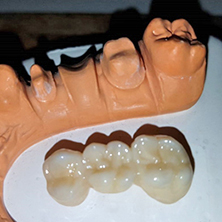 festsitzender Zahnersatz