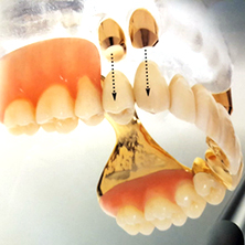 herausnehmbarer Zahnersatz